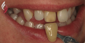 Teeth Whitening Telford Example