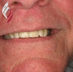 Man with new front teeth